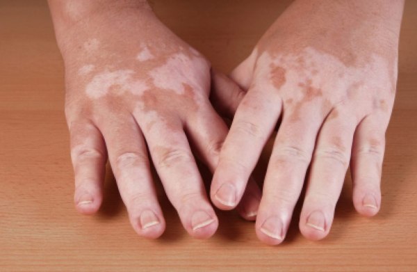 Пигментные заболевания кожи Пигментные заболевания кожи