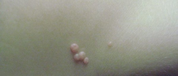 Удаление и лечение бородавок на теле