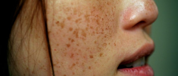 Как предотвратить появление пигментных пятен?