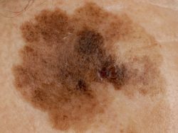 Гормональный сбой и пигментные пятна Гормональный сбой и пигментные пятна