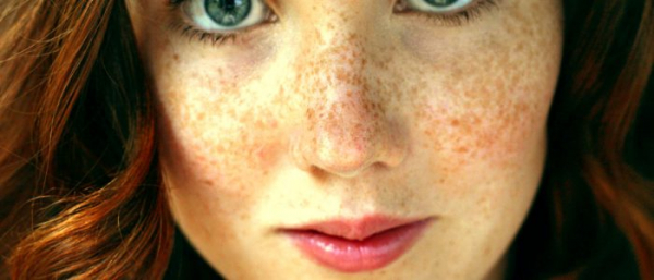 Пигментное пятно на лице после беременности Пигментное пятно на лице после беременности