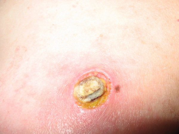 Плоская бородавка