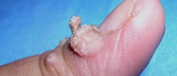 Типы бородавок