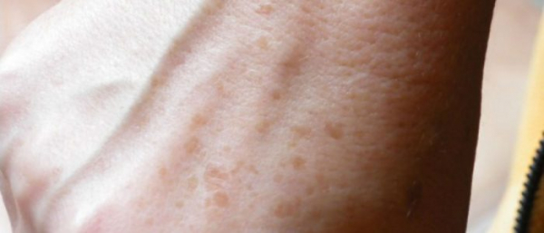 Пигментные заболевания кожи Пигментные заболевания кожи