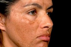 Салицилово-цинковая паста против прыщей Салицилово-цинковая паста против прыщей