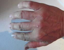 Как выглядят наросты? Как выглядят наросты?