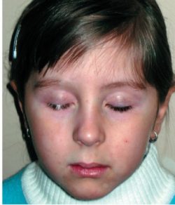 Белое пятно на коже Белое пятно на коже