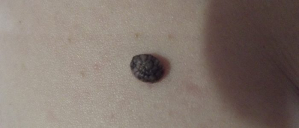 Черная бородавка Черная бородавка