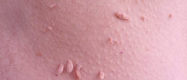 Бородавки под мышками Бородавки под мышками