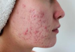 Салицилово-цинковая паста против прыщей Салицилово-цинковая паста против прыщей