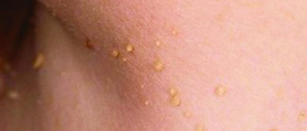 Бородавка на шее