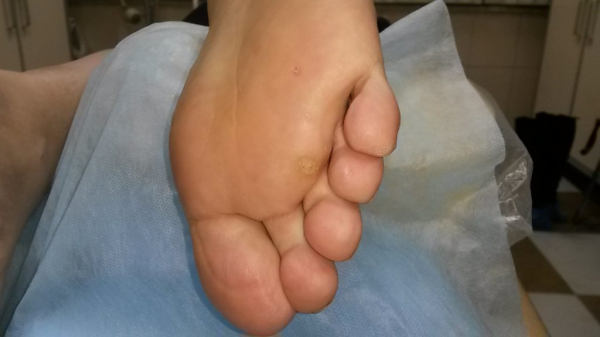 Подошвенные бородавки Подошвенные бородавки