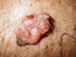 Бородавки под мышками Бородавки под мышками