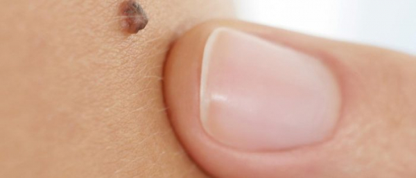 Нарост при беременности