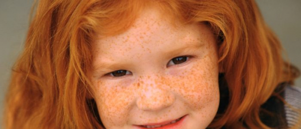 Веснушки у людей