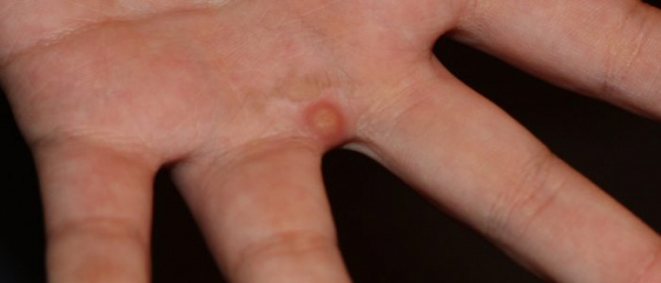 Шипица на руке и пальцах Шипица на руке и пальцах