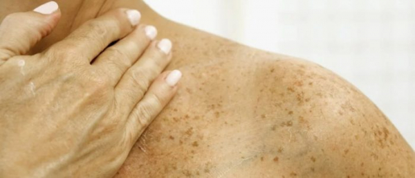 Возрастные пигментные пятна