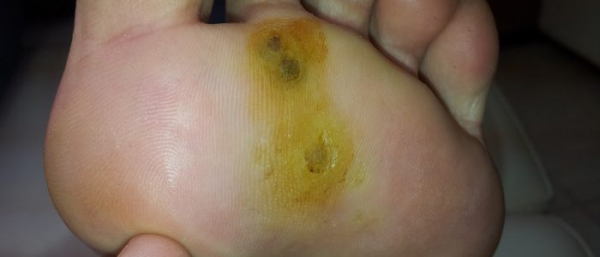 Как избавиться от подошвенных бородавок?