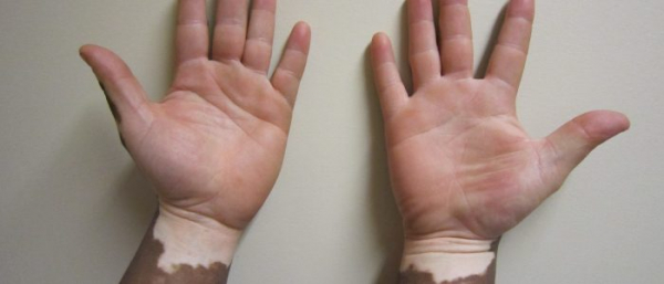 Депигментация кожи у ребенка