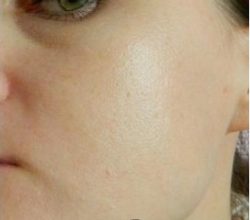 911 – крем от прыщей 911 – крем от прыщей