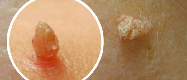 Бородавка на ножке