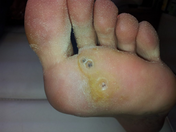 Подошвенные бородавки Подошвенные бородавки