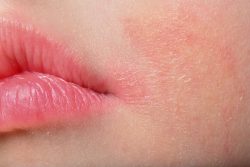 Салициловая мазь против прыщей Салициловая мазь против прыщей