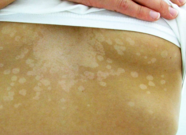 Белое пятно на коже Белое пятно на коже