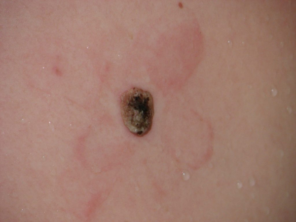 Черная бородавка Черная бородавка