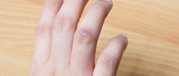 Повреждение бородавки