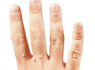 Подробнее о новом эффективном методе удаления бородавок в домашних условиях за 10 дней