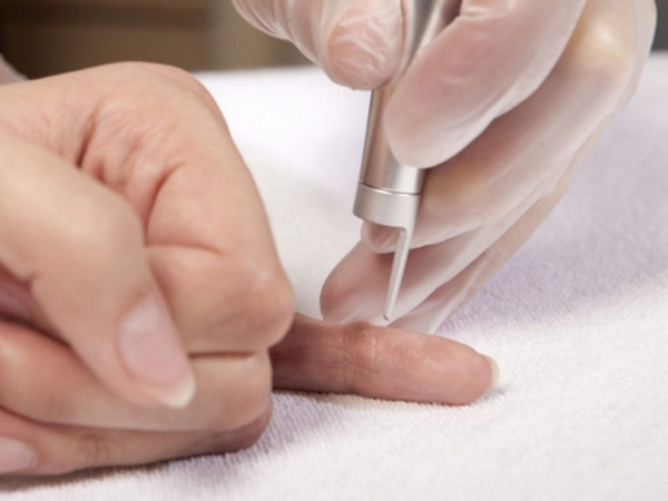 Выжигание бородавок лазером Выжигание бородавок лазером