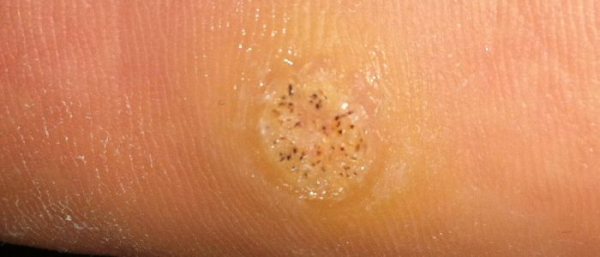 Как выглядят наросты? Как выглядят наросты?