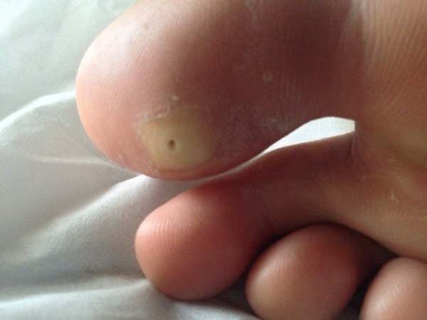 Подошвенные бородавки у детей Подошвенные бородавки у детей