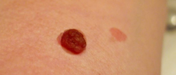 Красная бородавка на коже