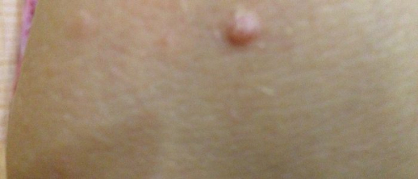 Плоская бородавка