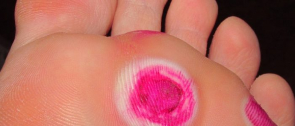 Подошвенные бородавки у детей Подошвенные бородавки у детей