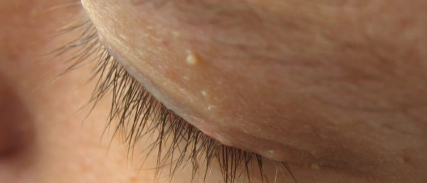 Удаление бородавок на веке Удаление бородавок на веке