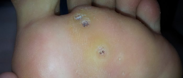 Подошвенные бородавки Подошвенные бородавки