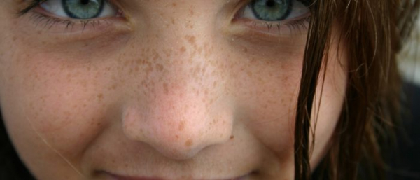 Как избавится от пигментных пятен под глазами?