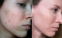 Салициловая кислота против прыщей Салициловая кислота против прыщей