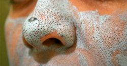 Салициловая кислота против прыщей Салициловая кислота против прыщей