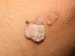 Как выглядят наросты? Как выглядят наросты?