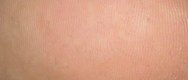 Могут ли расти бородавки?