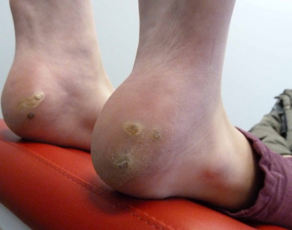 Подошвенные бородавки Подошвенные бородавки