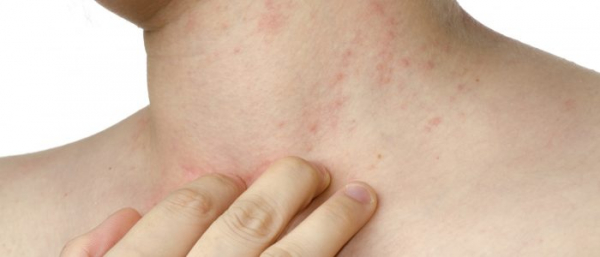 Почему пигментные пятна чешутся?