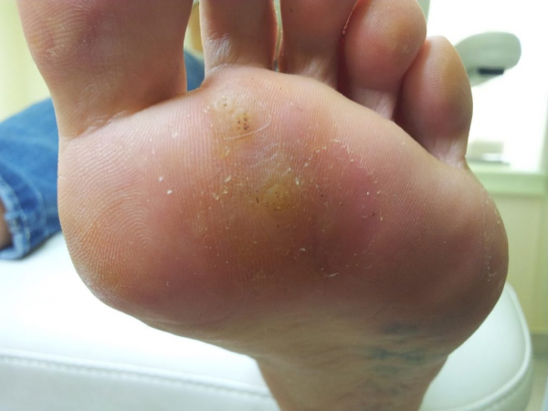 Подкожные бородавки Подкожные бородавки