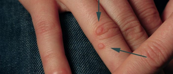 Могут ли бородавки исчезнуть сами?