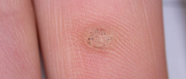 Воспаление бородавки