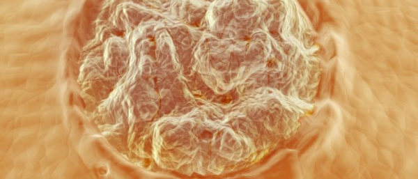 Нитевидные папилломы